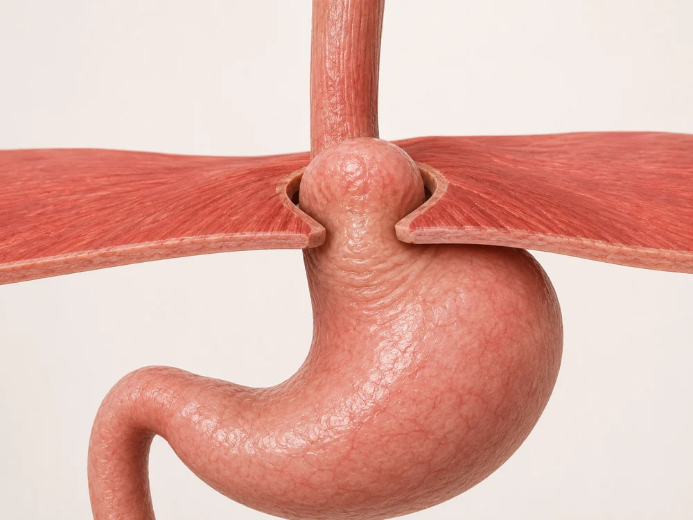 Ilustración de una hernia de hiato: el estómago asciende por el diafragma